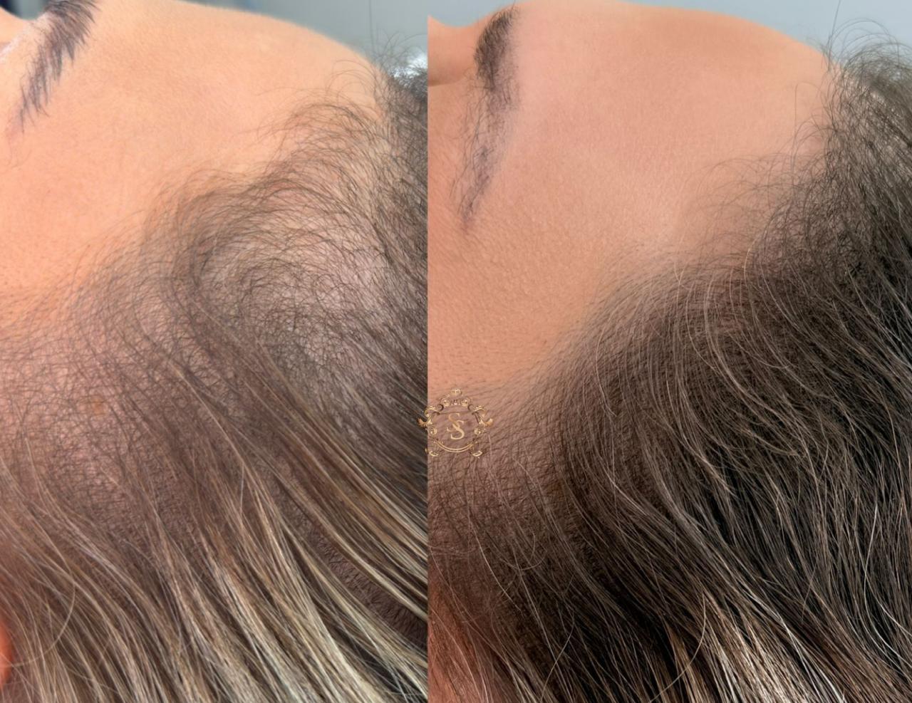 Antes e Depois ExoHair 2