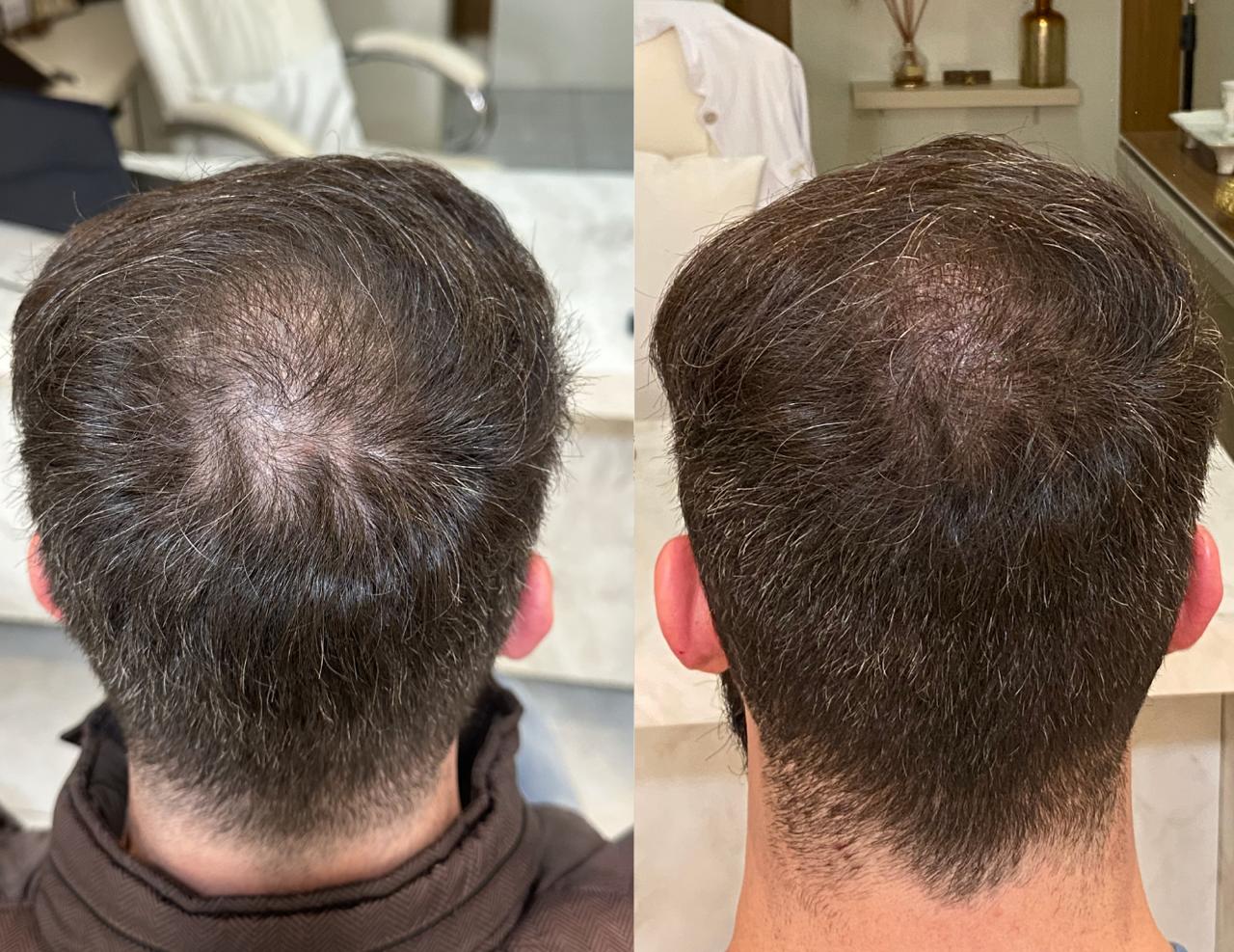 Antes e Depois ExoHair 3