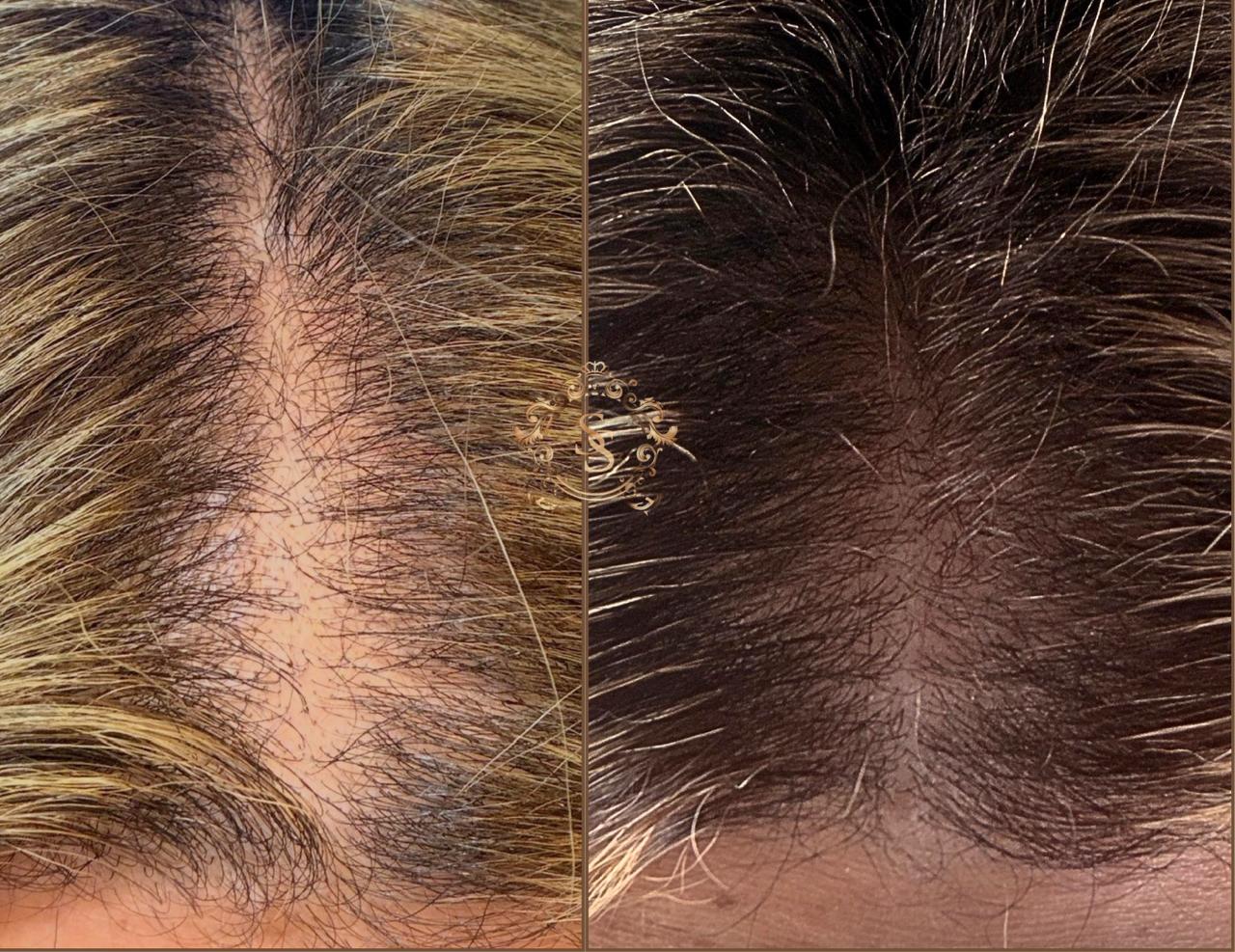 Antes e Depois ExoHair 4