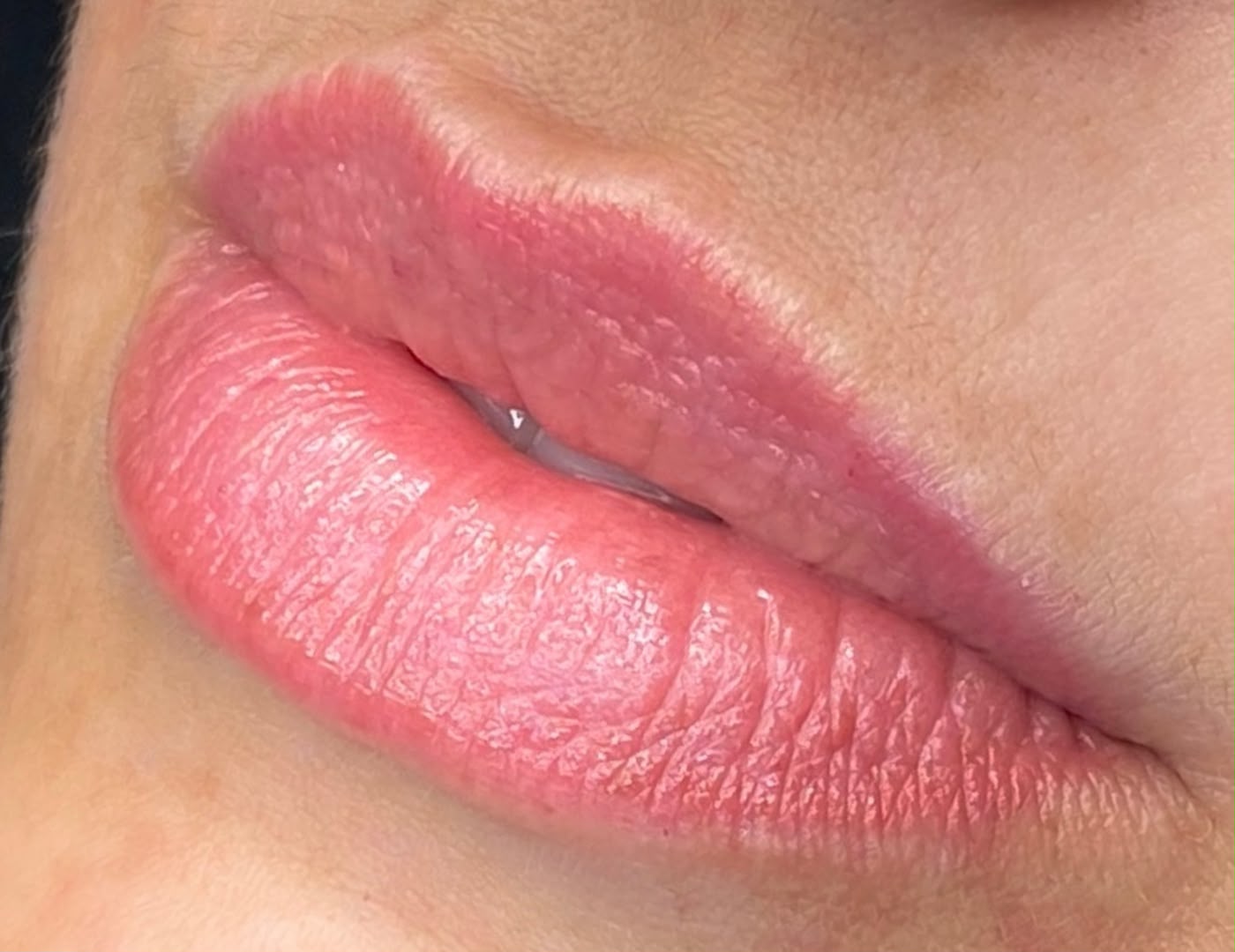 Revitalização Labial