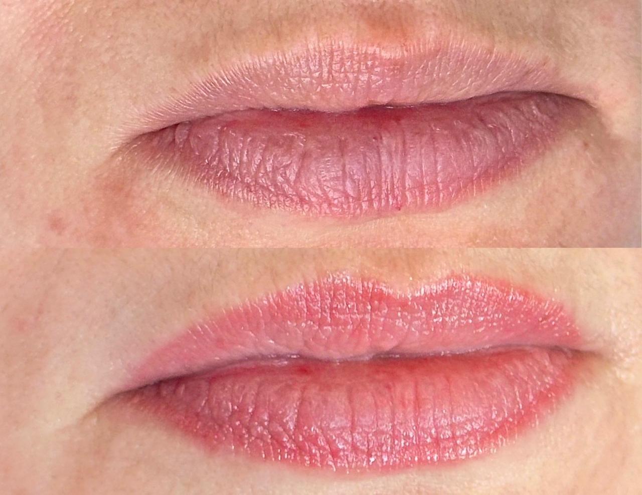 Revitalização Labial Antes e Depois 3