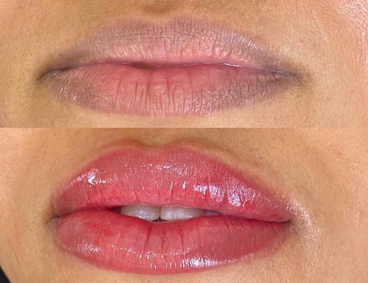Revitalização Labial Antes e Depois 4