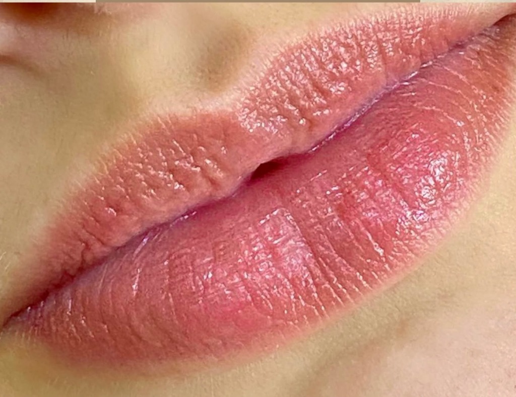 Revitalização Labial Antes e Depois 2